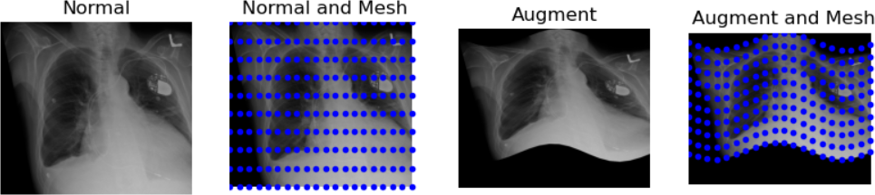 augmented by waves chest x-ray