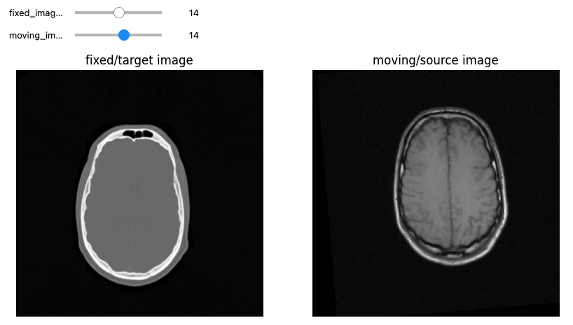 CT and MRI volumes before being aligned.