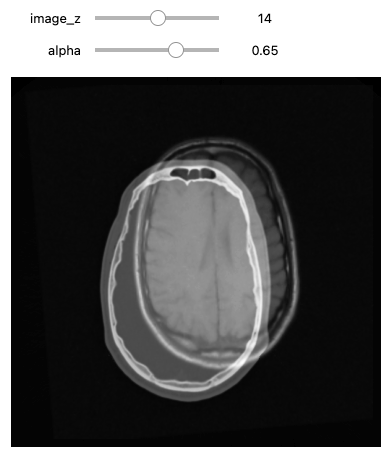 CT and MRI volumes overimposed.