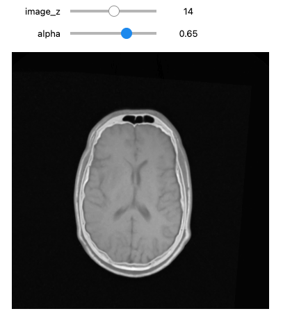 CT and MRI volumes aligned.