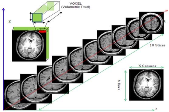 MRI slices