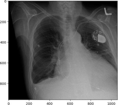 augmented by shear chest x-ray